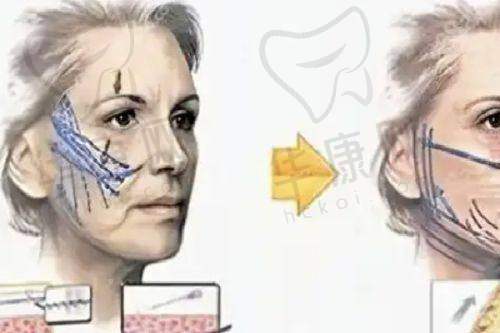 西安西美医院可以做直腿术吗多少钱？2.5 - 6万综合方案打造自然美腿