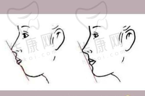 殷初阳隆胸手术价格如何?实惠合理暖人心