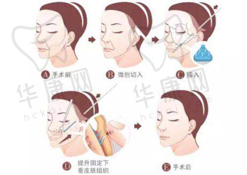 肿眼泡人群如何选择合适的双眼皮手术?