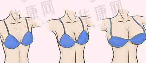 西安西美整形医院直腿术真实实例分享