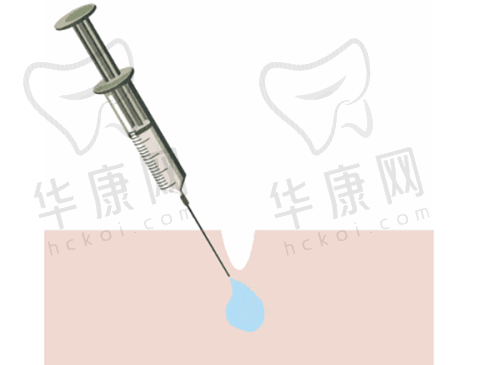 上海曼领赵鑫:手术过程与感受