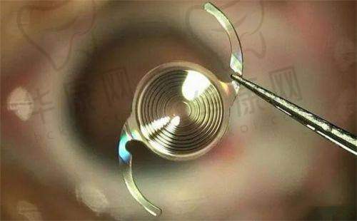上饶启明眼科医院王维敬超声乳化手术3000元起，精湛医术开启白内障高效治疗之旅！