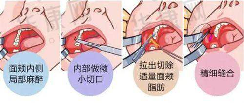 处女膜修复术后首次同房出血有哪些表现及应对方法？