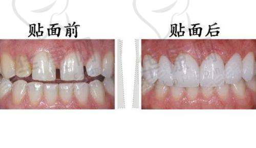 牡丹江美植口腔全瓷牙贴面仅998元起，连锁品牌正规专业定制方案！