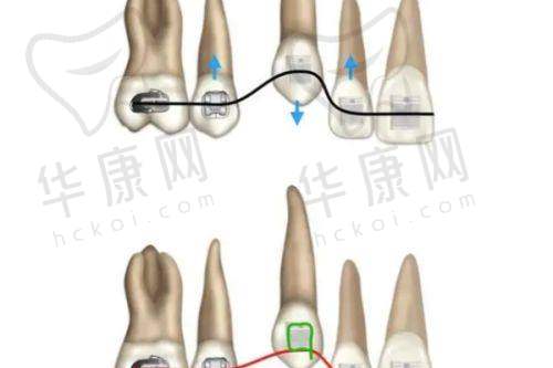 雅安优诺口腔国产隐形矫正22000元起，性价比之选开启牙齿矫正新体验