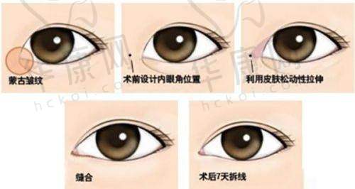 上睑提肌手术改善轻度上睑下垂成效如何?