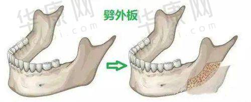 胡俊杰医生的人中沟加深技术优势在哪?