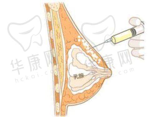 选择鼻小柱延长材料的其他注意事项