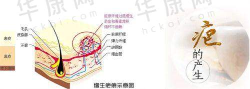 深圳鹏程医院疤痕科的个性化治疗方案是怎样制定的？