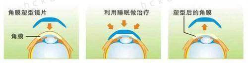 兰州普瑞眼科医院如何挂号?