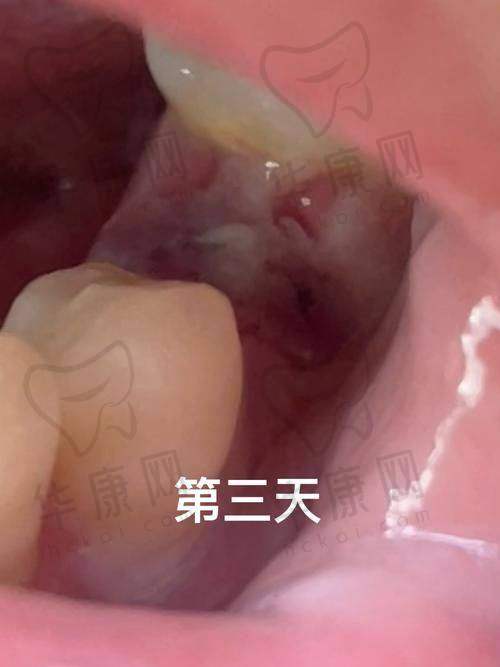 雅安优诺口腔上颌智齿拔牙289元起，低价优质服务开启舒适拔牙新体验