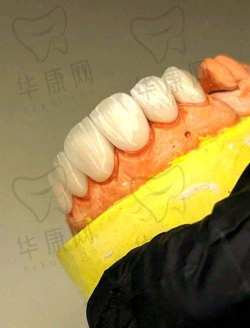 牡丹江美植口腔全瓷牙贴面服务特色