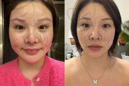 沈阳沈河腾采医疗美容孟强面诊体验