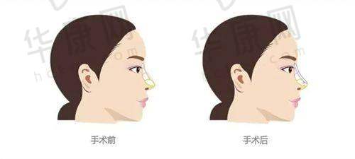 术后的护理与修复