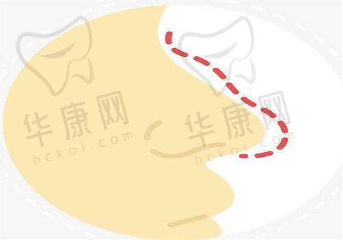 广州军美王世虎自体脂肪填充技术亮点