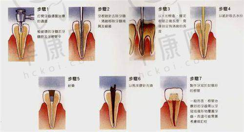 成都西南口腔医院根管治疗的初体验