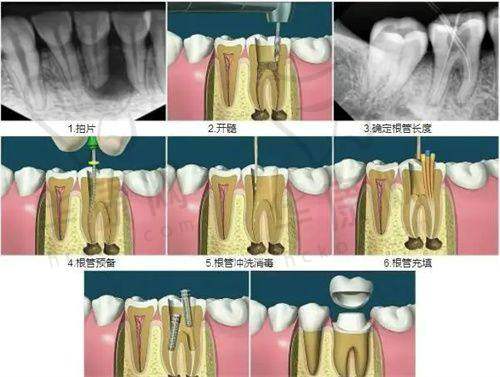 成都西南口腔医院根管治疗的具体过程