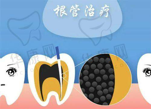 成都西南口腔医院根管治疗后的成效