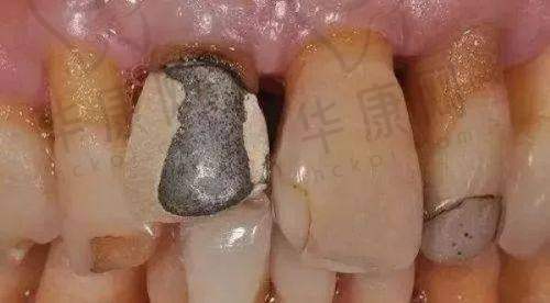 淮安诺贝尔口腔医院烤瓷牙400元起，多样材质与专业服务打造优质口腔修复体验