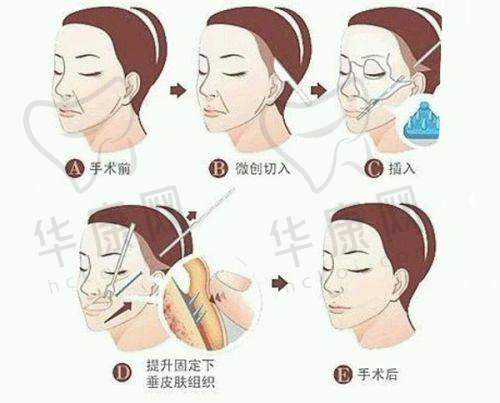巨乳缩小术真的能让胸部变小又提升美观度吗?
