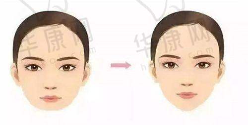 李朕医生的LZ大颗粒脂肪丰胸技术,如何确保自体脂肪隆胸成活率高?