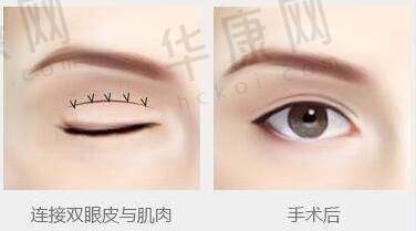 美莱整形做超声炮有哪些注意事项?