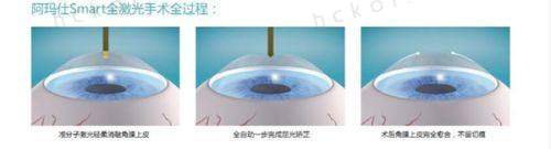 苏州光明眼科医院ICL晶体植入适合人群