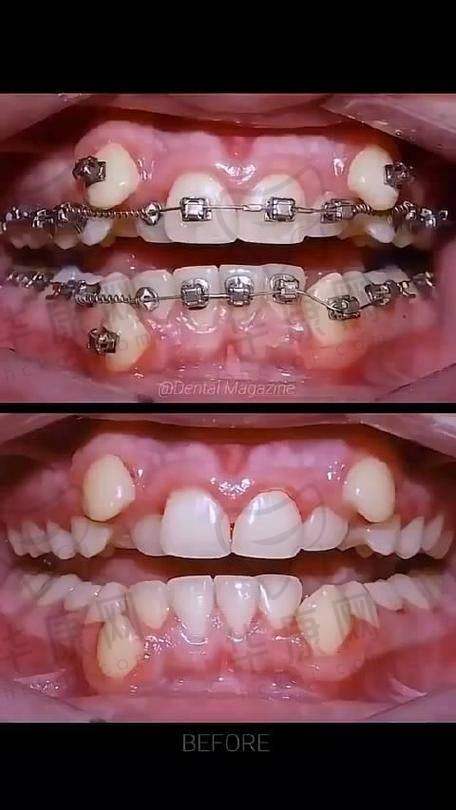 商丘京德口腔医院时代天使隐形矫正与其他项目的性价比对比