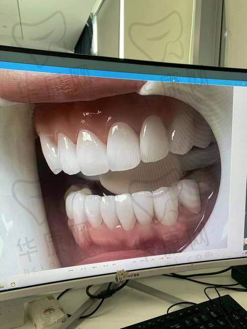 重庆贝乐嘉口腔医院E-Max瓷贴面1280元起，品质优价格美超划算