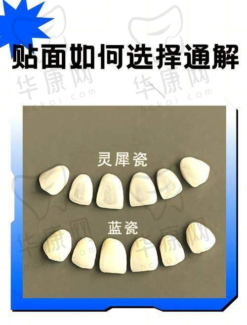 重庆贝乐嘉口腔医院E-Max瓷贴面与其他项目的关联