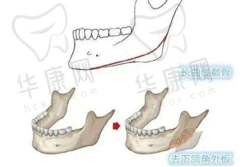 哪些因素会影响3D生物束带缩阴成效的维持时间？