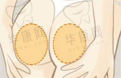 2024哈尔滨瑞丽整形医院隆胸价格贵吗？