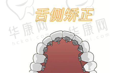 深圳万丰医院口腔科金属托槽矫正的技术优势