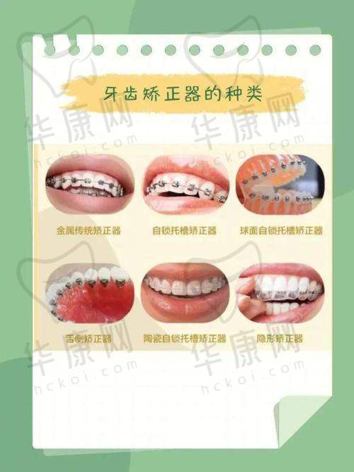 正雅经典版隐形矫正的成效与体验