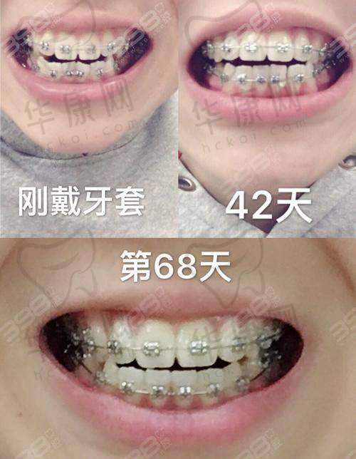 深圳万丰医院口腔科金属托槽矫正的服务特色