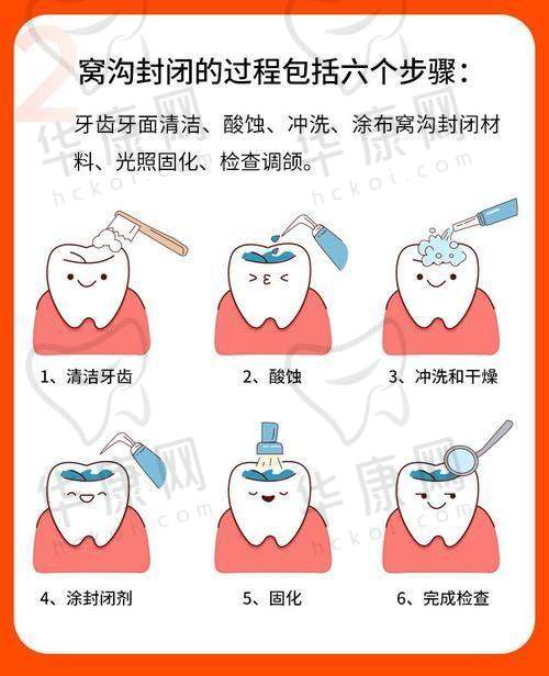 西昌春城口腔儿童窝沟封闭58元起，低价护齿，为孩子口腔健康保驾护航！