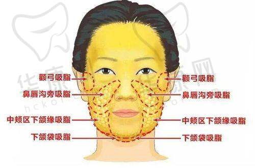 杜太超小切口面部提升术中体验