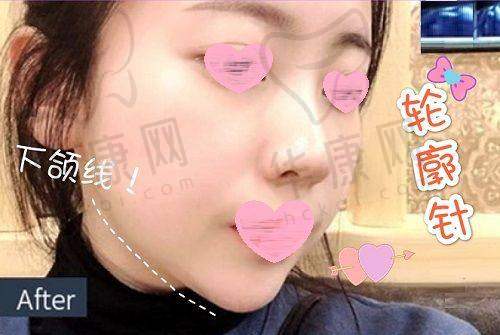 烟台鹏爱美容整形医院魏璐医生预约方式