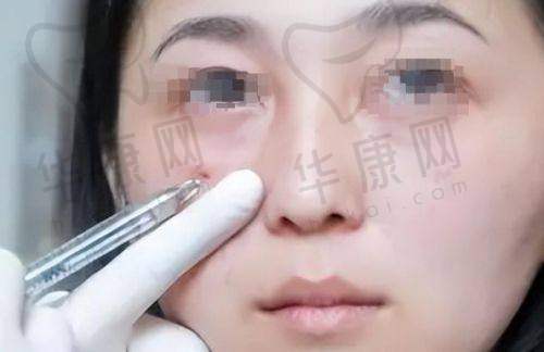 青岛博士医疗美容医院杨永胜超肋鼻综合的成功实例