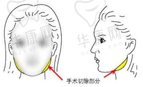 手术过程的感受