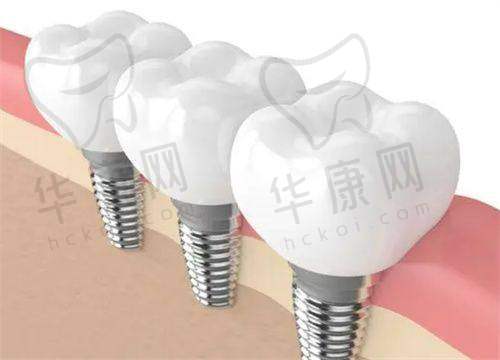 全口即刻种植的成效与感受