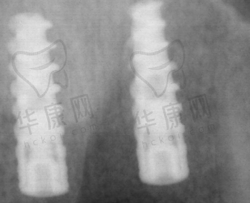 全口即刻种植佩戴临时牙冠