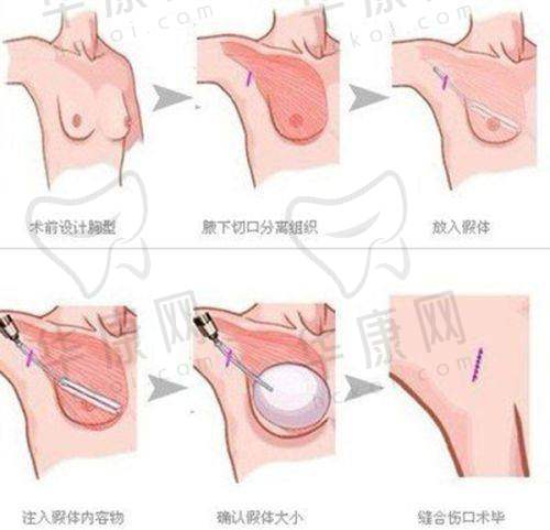 顾客对济南诺德医疗美容医院陈三群双眼皮修复的评价