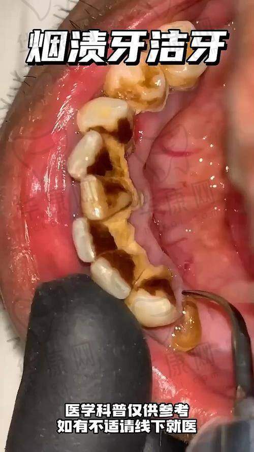 龙岩博恩口腔在超声波洁牙方面的医院优势
