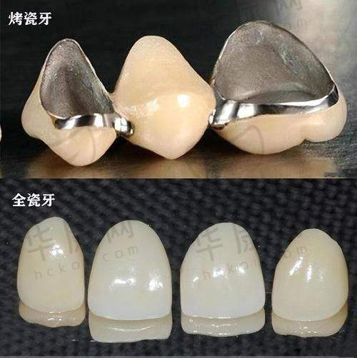 总结全瓷美学修复及运城运中口腔医院体验
