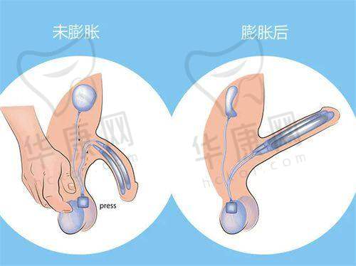 眼部整形:美杜莎眼综合的精细艺术