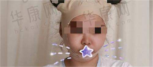 杭州韩美整形杨珏萍医生的微整和轮廓固定技术好不好?