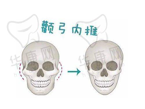 术后修复:成效显著