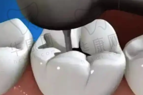 龙岩博恩口腔在3MZ350树脂补牙方面的技术优势