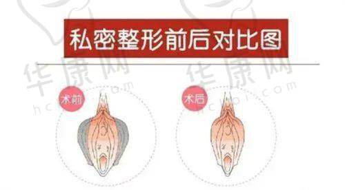 术后不同阶段的睡姿建议是怎样的？